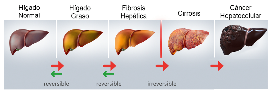 Evolución del hígado graso