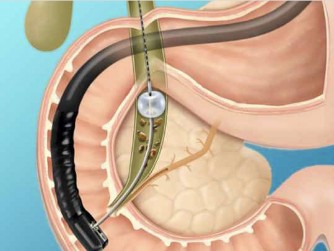 Ретроградная папиллотомия. Эндоскопическая литоэкстракция. Стент желчного протока